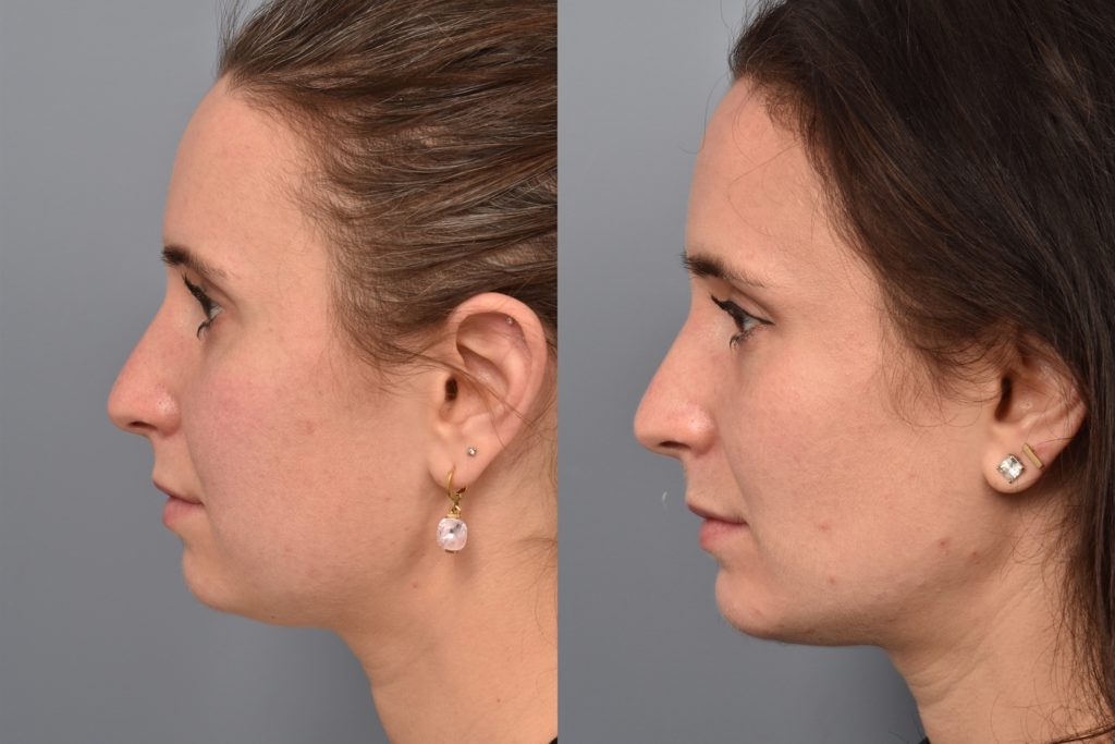 patient before and after buccal fat removal