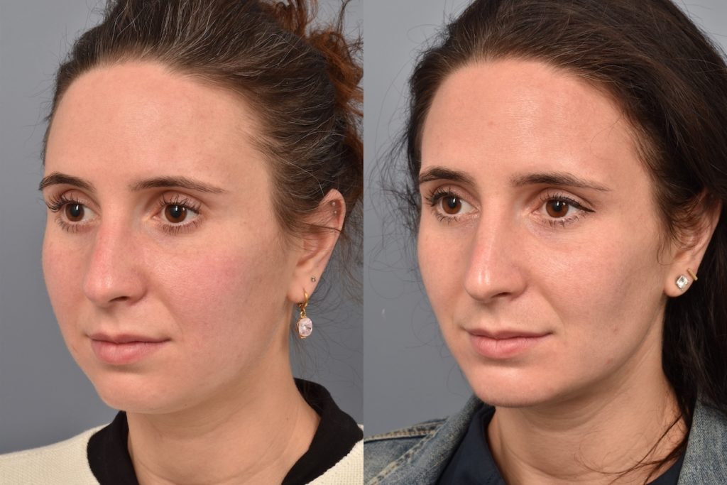 patient before and after buccal fat removal