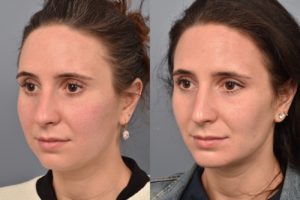 patient before and after buccal fat removal