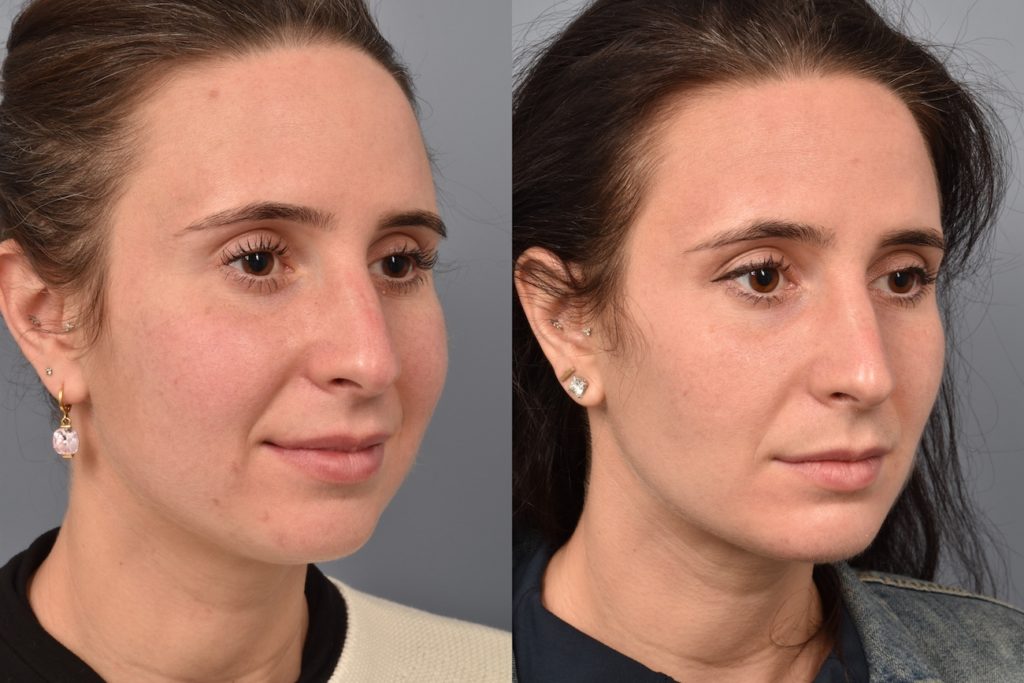 patient before and after buccal fat removal