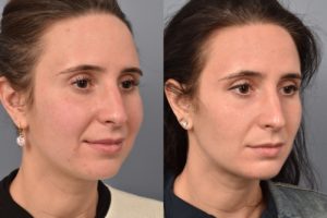 patient before and after buccal fat removal