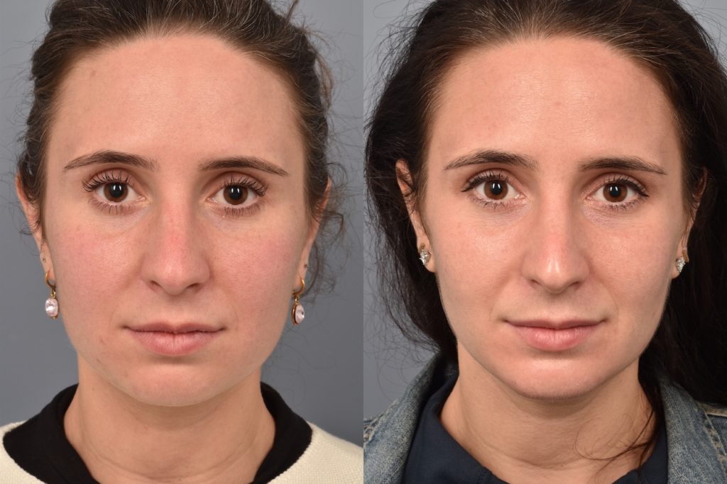 patient before and after buccal fat removal