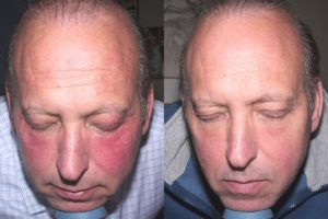 patient before and after BBL