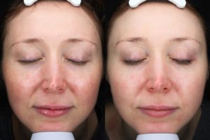 patient before and after BBL