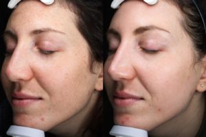 patient before and after BBL