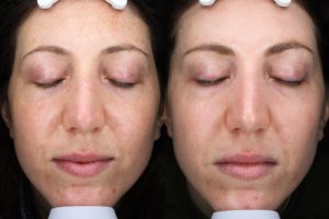 patient before and after BBL