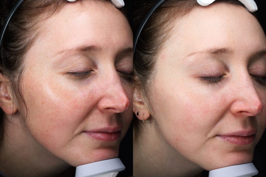 patient before and after BBL