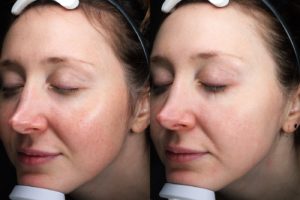 patient before and after BBL