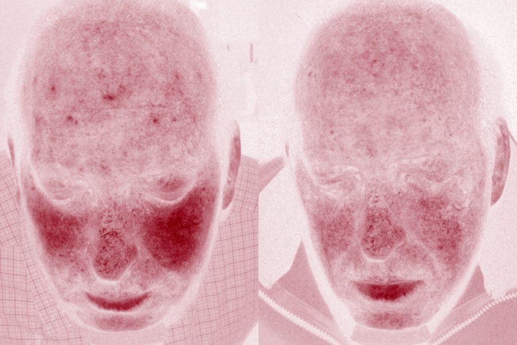 patient before and after BBL