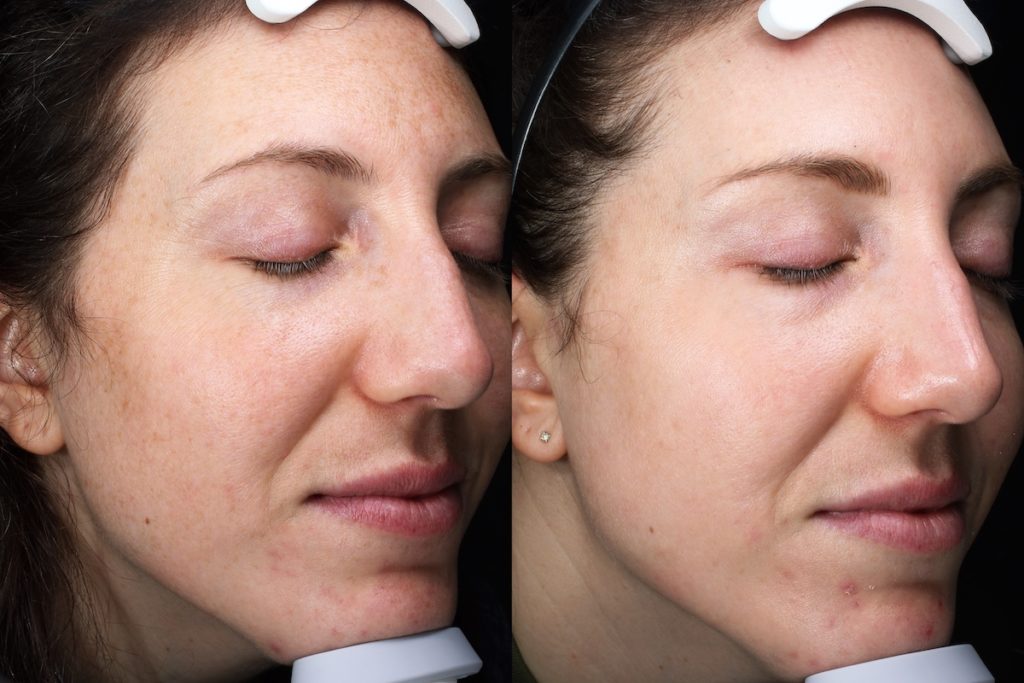 patient before and after BBL