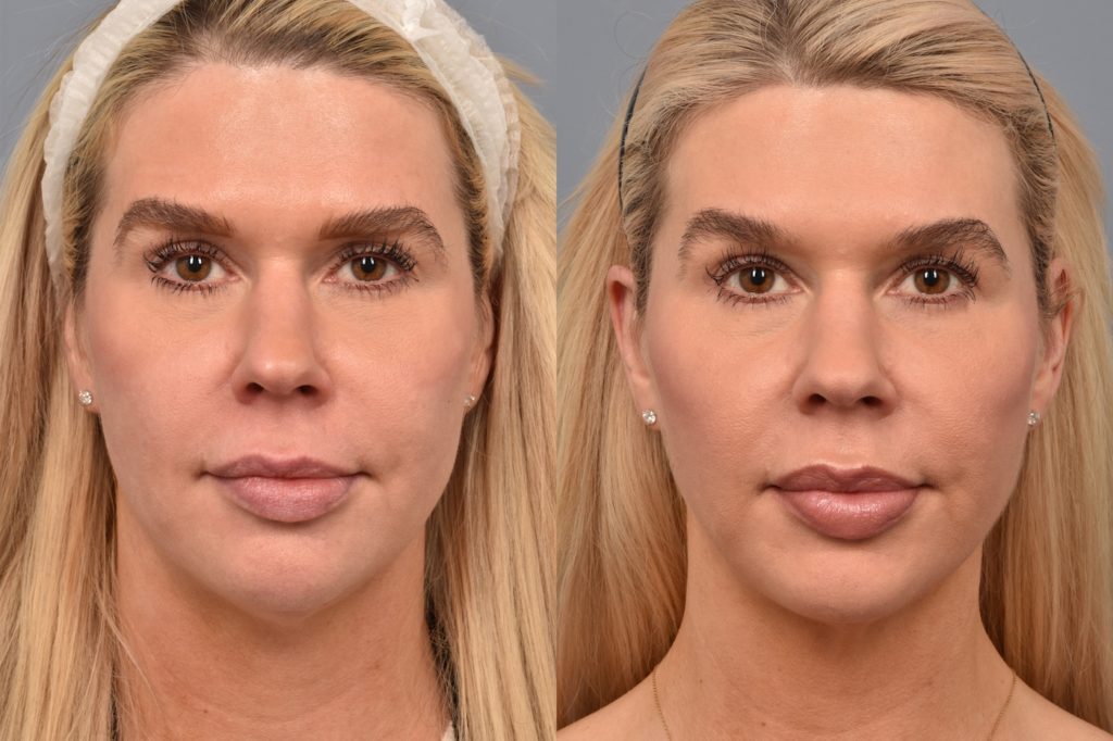 patient before and after ultherapy