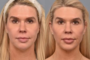 patient before and after ultherapy