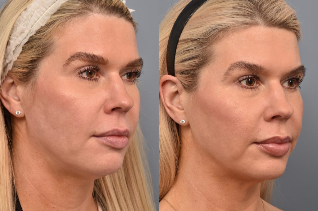 patient before and after ultherapy