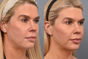 patient before and after ultherapy