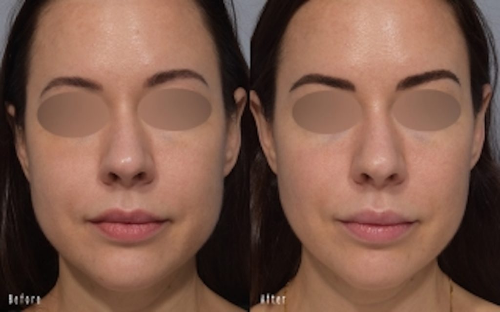 patient before and after ultherapy