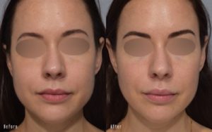 patient before and after ultherapy