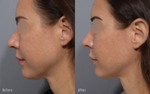 patient before and after ultherapy