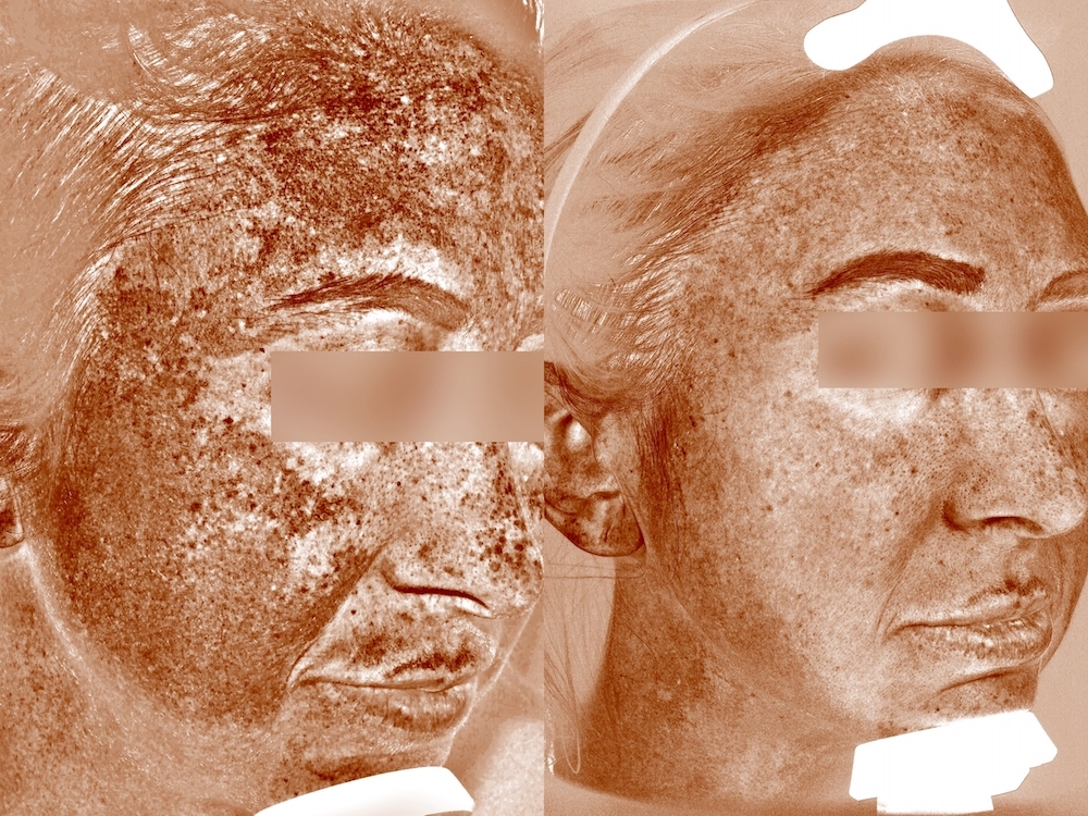 patient before and after HALO