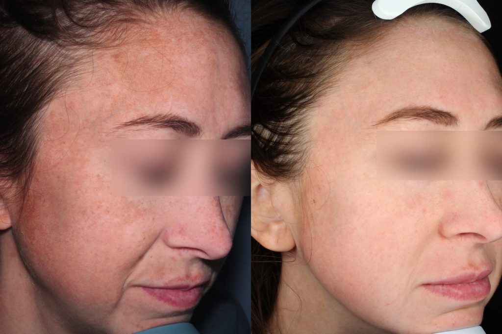 patient before and after HALO