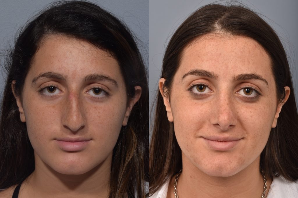 patient before and after rhinoplasty