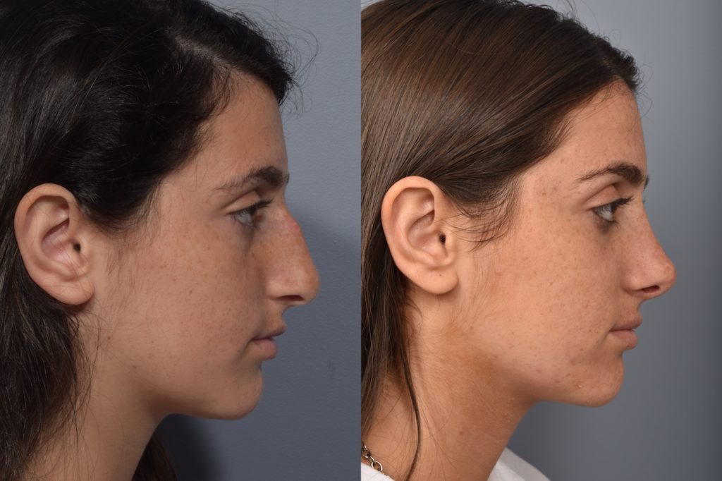 patient before and after rhinoplasty