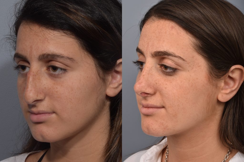 patient before and after rhinoplasty