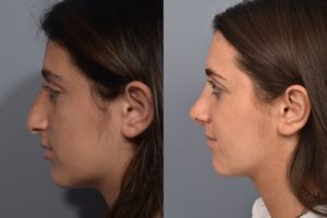 patient before and after rhinoplasty