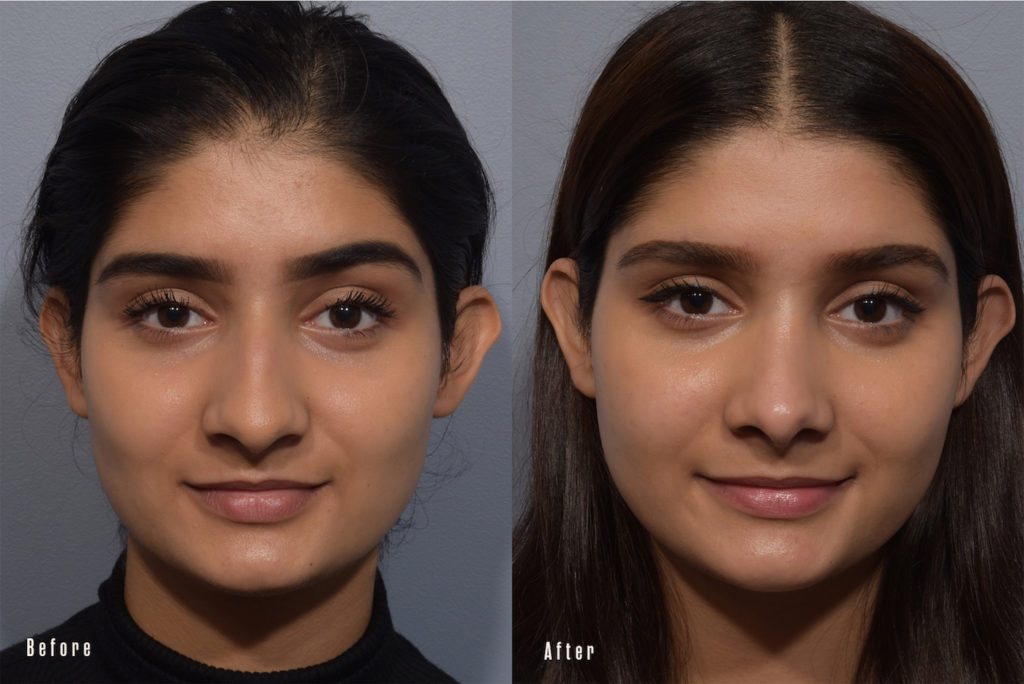 patient before and after rhinoplasty