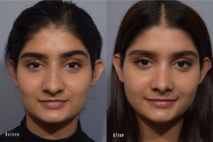patient before and after rhinoplasty