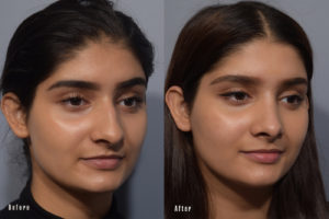 patient before and after rhinoplasty