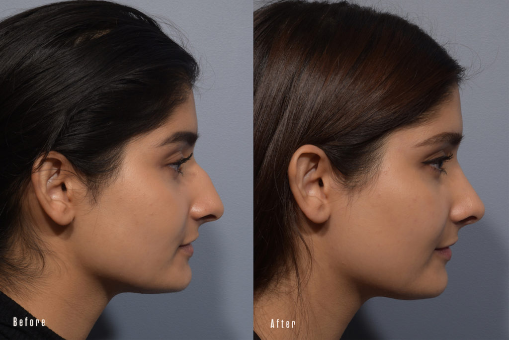 patient before and after rhinoplasty