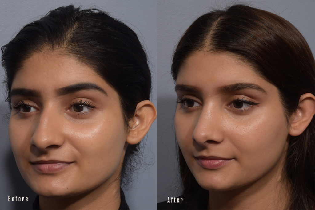 patient before and after rhinoplasty