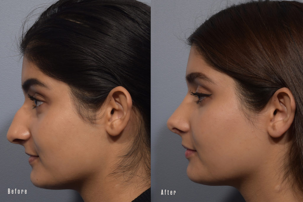 patient before and after rhinoplasty