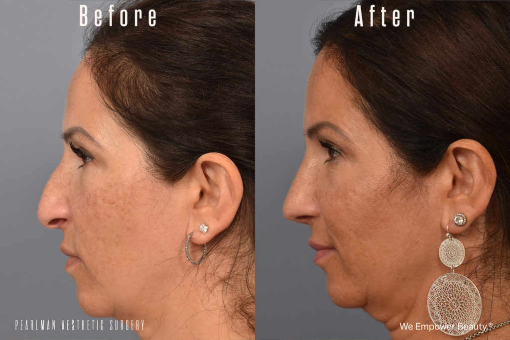 patient before and after rhinoplasty