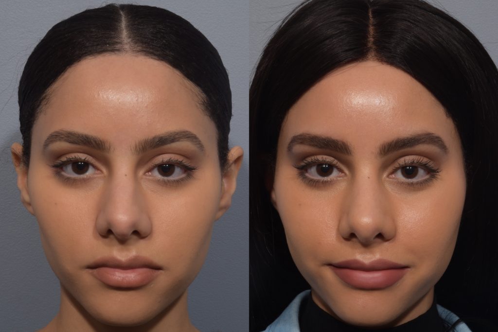 patient before and after rhinoplasty