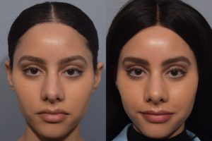 patient before and after rhinoplasty