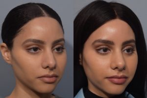 patient before and after rhinoplasty