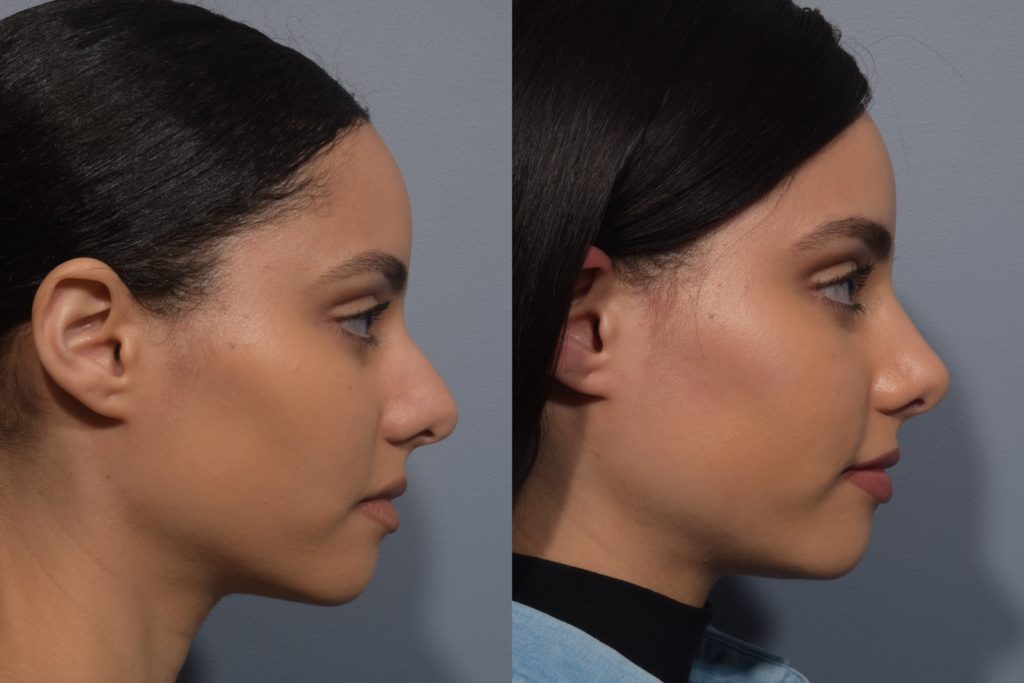 patient before and after rhinoplasty