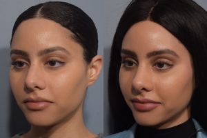 patient before and after rhinoplasty