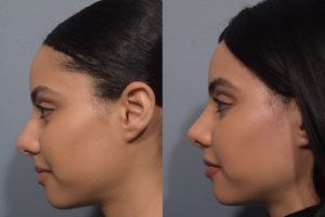patient before and after rhinoplasty
