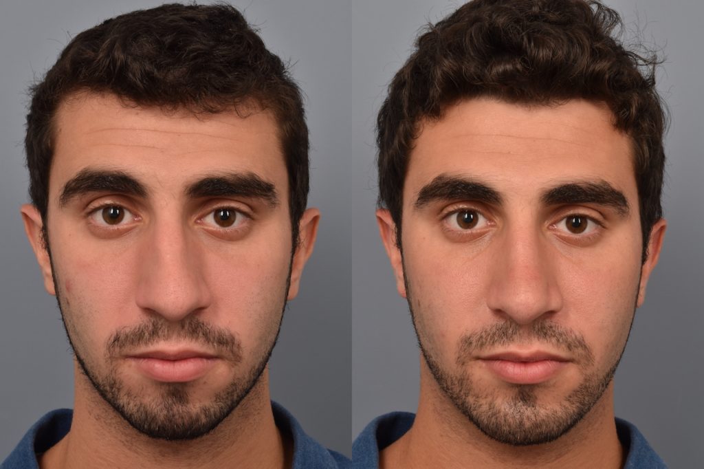 patient before and after rhinoplasty and chin implant