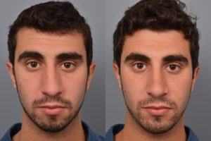 patient before and after rhinoplasty and chin implant