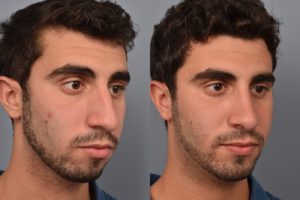 patient before and after rhinoplasty and chin implant
