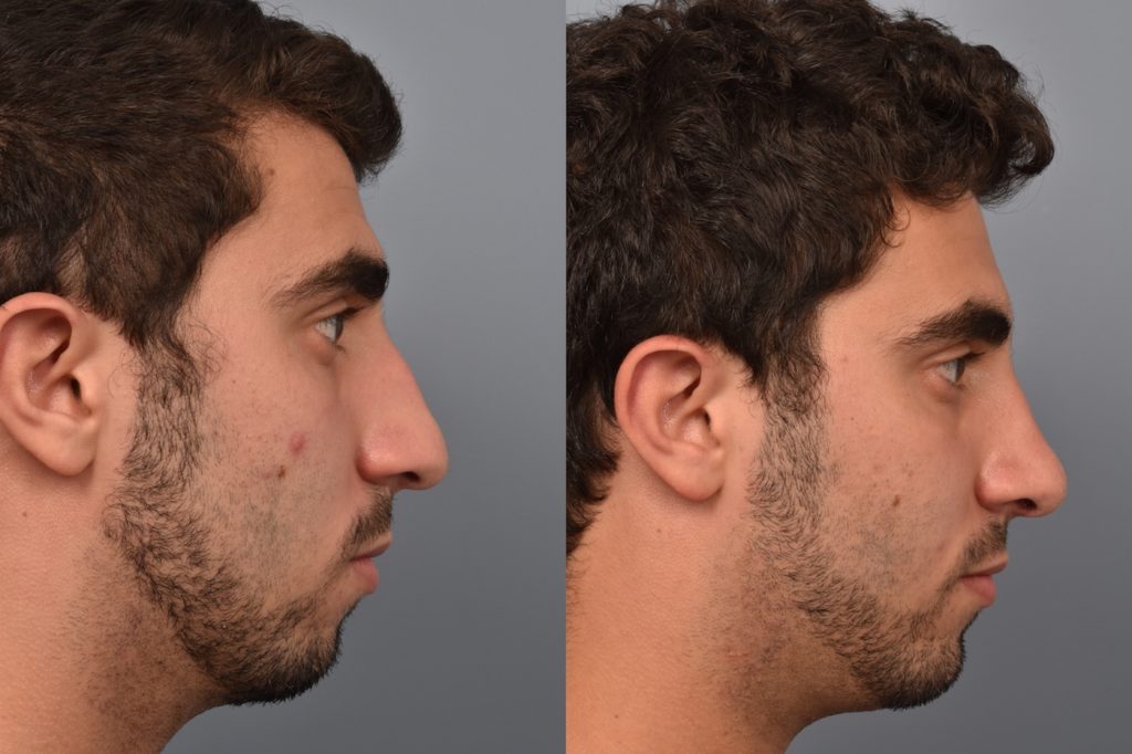 patient before and after rhinoplasty and chin implant