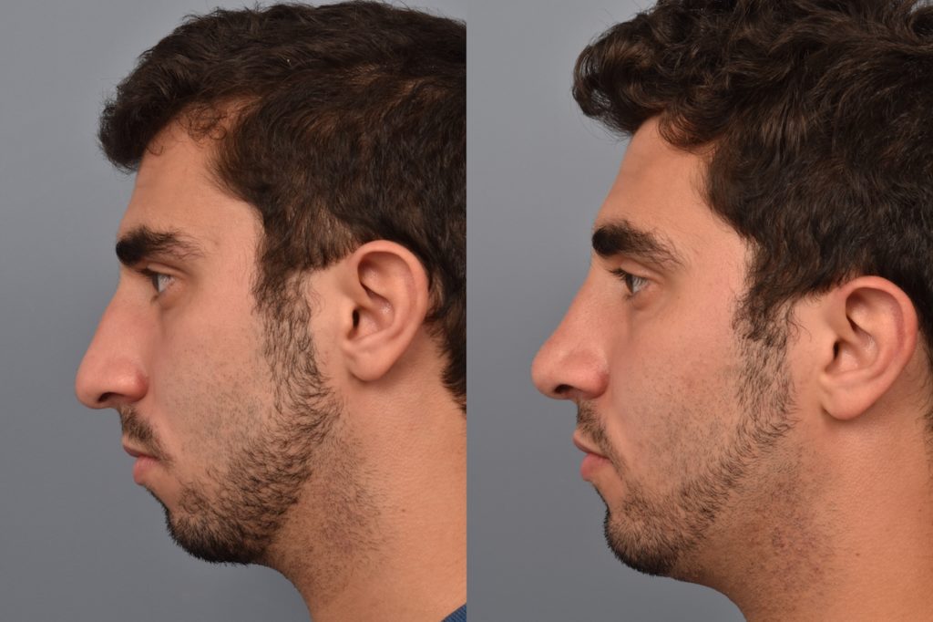patient before and after rhinoplasty and chin implant