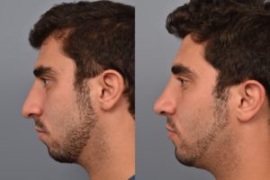 patient before and after rhinoplasty and chin implant