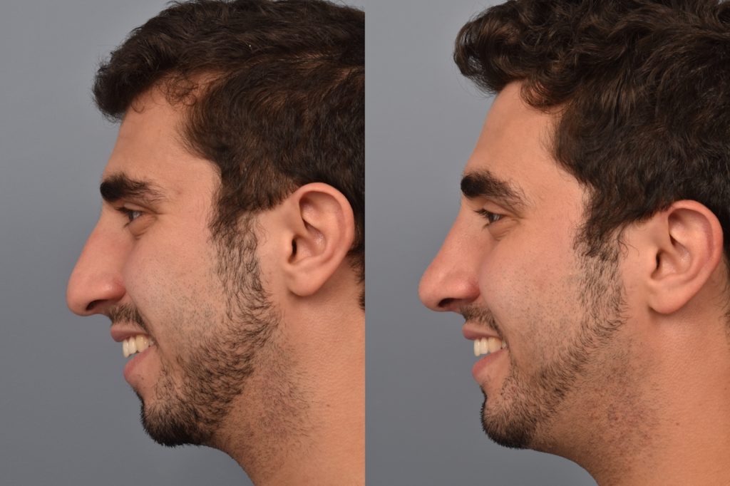 patient before and after rhinoplasty and chin implant
