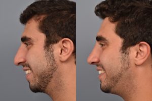 patient before and after rhinoplasty and chin implant