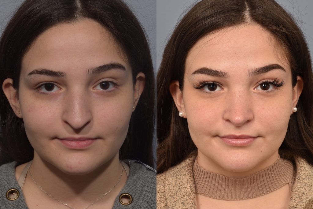 patient before and after rhinoplasty