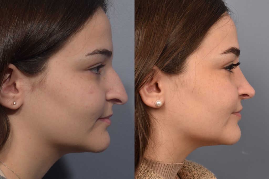 patient before and after rhinoplasty